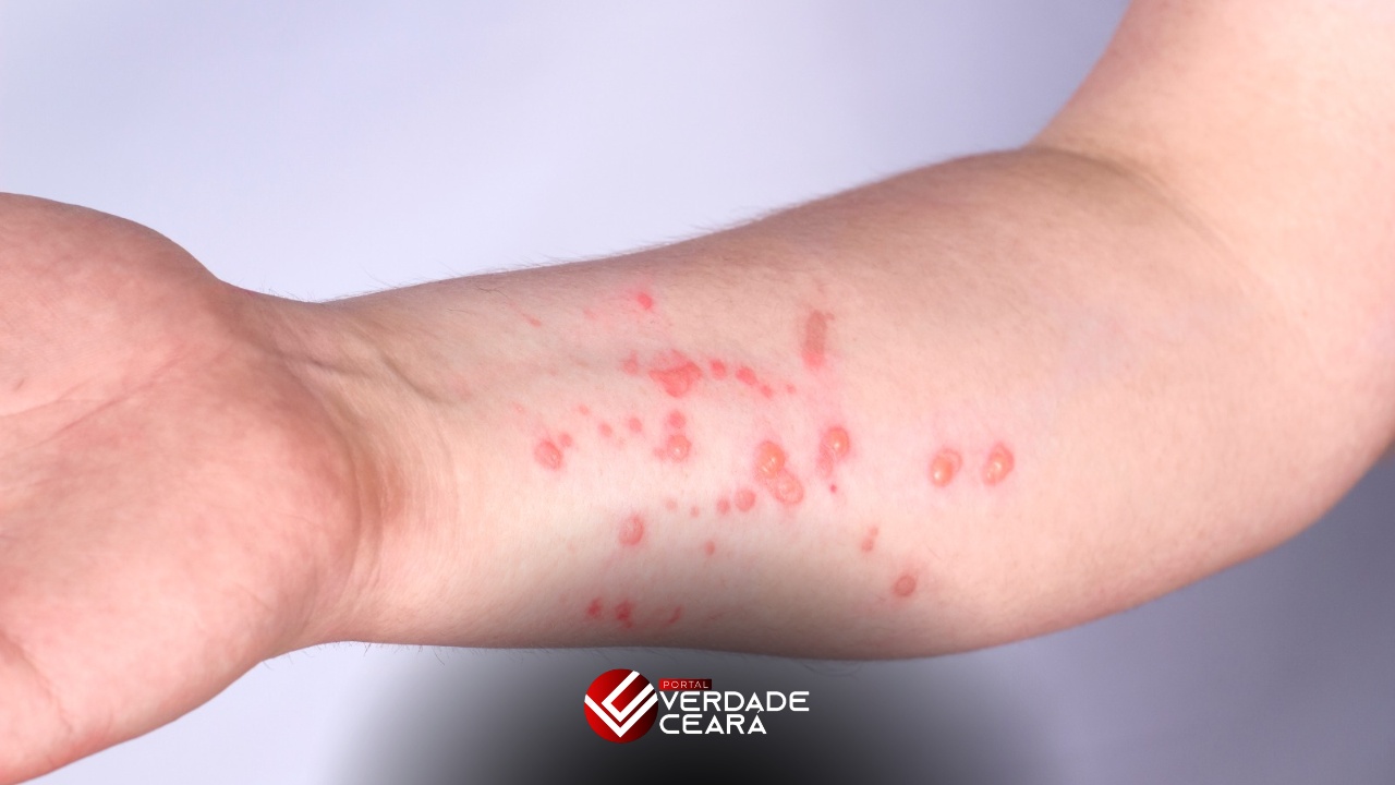 O Ceará confirmou o primeiro caso de Mpox em 2026